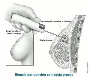core biopsia de seno