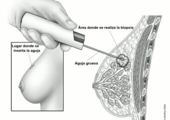 ¿Qué es la Biopsia Core de Mama o Biopsia de Seno?